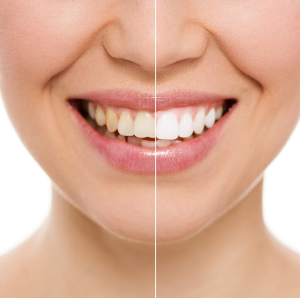 Whiten Teeth Safely at Home